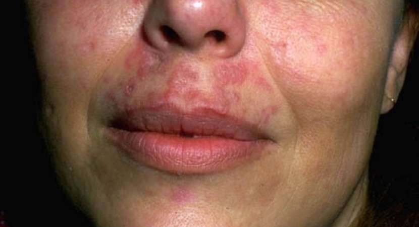 Study finds Low Vitamin D may up risk of renal disease in lupus patients Study finds Low Vitamin D may up risk of renal disease in lupus patients