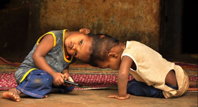 Odisha conjoined twins: Jagga shows improvement, Kalia still critical Odisha conjoined twins: Jagga shows improvement, Kalia still critical