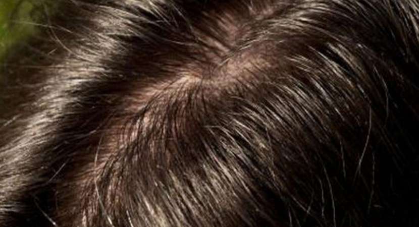 Save your scalp from dryness by avoiding chemical treatments Save your scalp from dryness by avoiding chemical treatments