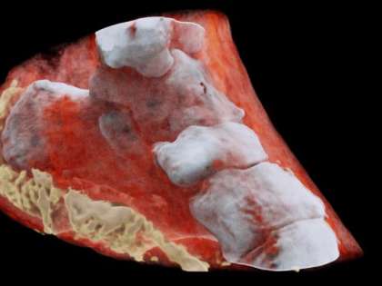 This picture has been released on July 12, 2018, by MARS Bioimaging Ltd. It shows a 3D image of the left view of an ankle with bones in white and soft tissue in red. (AFP Photo) This picture has been released on July 12, 2018, by MARS Bioimaging Ltd. It shows a 3D image of the left view of an ankle with bones in white and soft tissue in red. (AFP Photo)