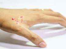 Snake Bite: Get the Facts About Symptoms and Treatment