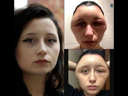 19-year-old woman face expanded and started to look like a light bulb after applying hair dye 19-year-old woman face expanded and started to look like a light bulb after applying hair dye