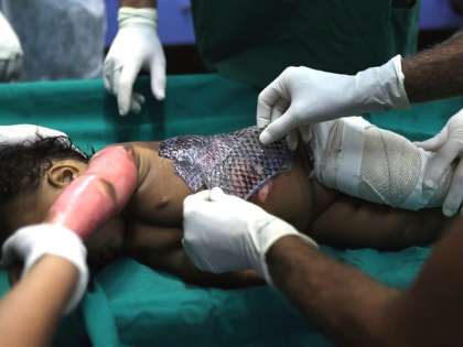Fish skin cheaper, less painful in treating burns than bandages: Scientist Fish skin cheaper, less painful in treating burns than bandages: Scientist